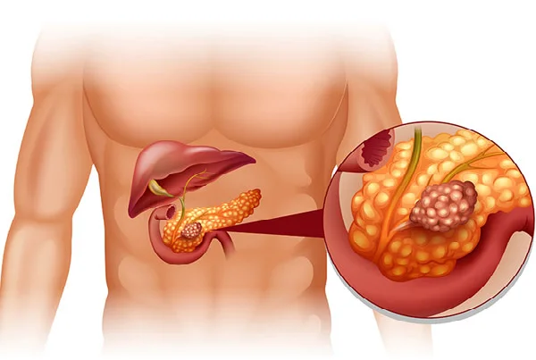 Pancreatic Diseases