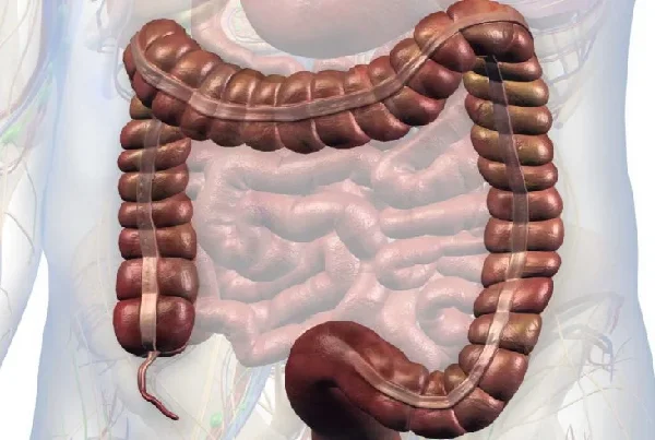 Large Intestine and Colon Surgery